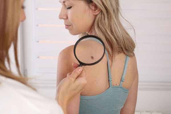 What Are Traditional Skin Lesion Removal Methods Berkhamsted?