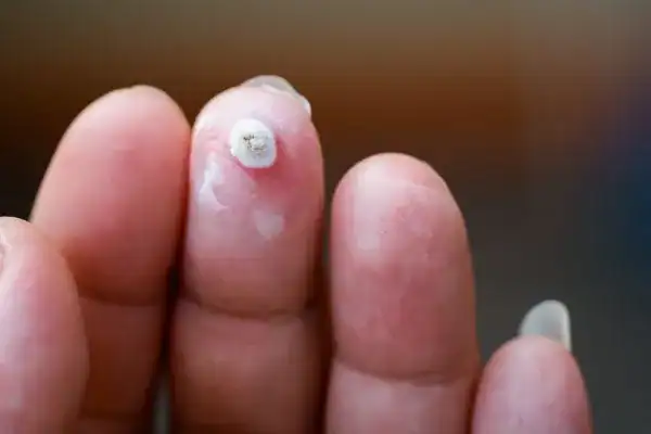 Image of white wart before cryopen treatment Berkhamsted