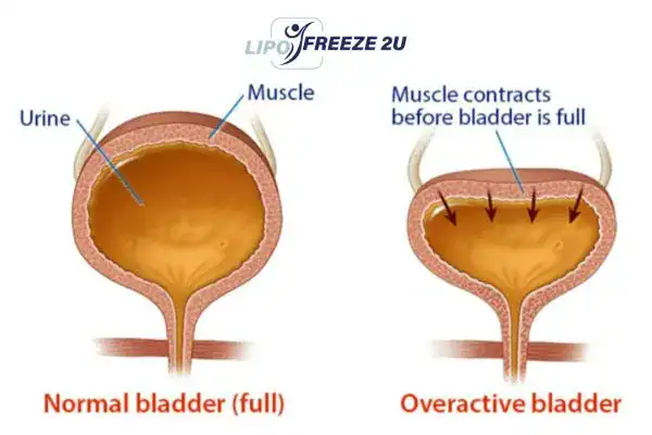 diagram of overactive bladder treatment Berkhamsted