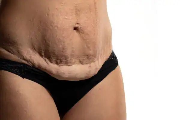 loose skin after weight loss injections Berkhamsted