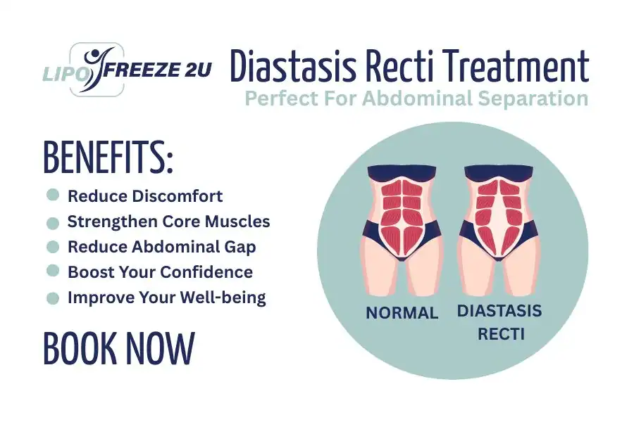 How Long Will It Take to See Improvements in Diastasis Recti Berkhamsted