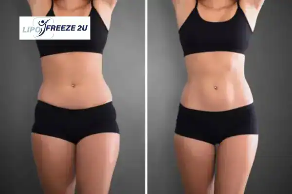 How Can LIPO FREEZE 2U Support Your Post-Pregnancy Body Recovery Berkhamsted?