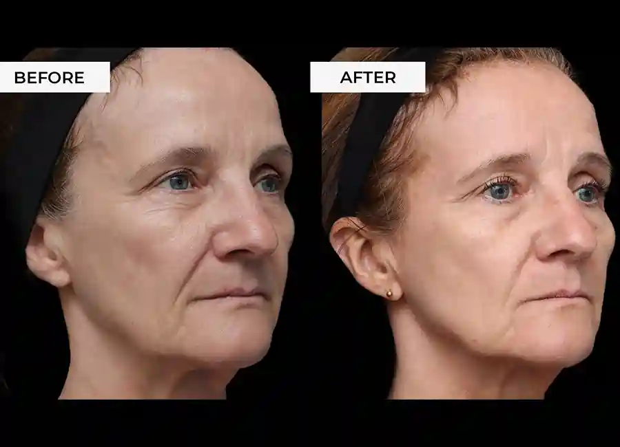How Many RF Microneedling Sessions Will You Need to See a Difference Berkhamsted?